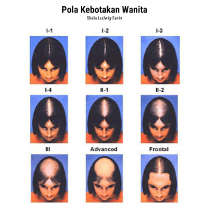 pola kebotakan rambut wanita skala ludwig-savin