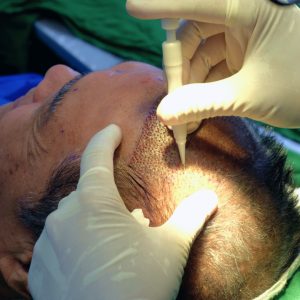 Program Hair Transplant harga Tanam Rambut FUE DHI