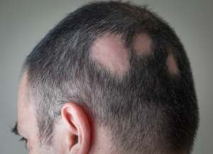 kebotakan tidak merata alopecia areata