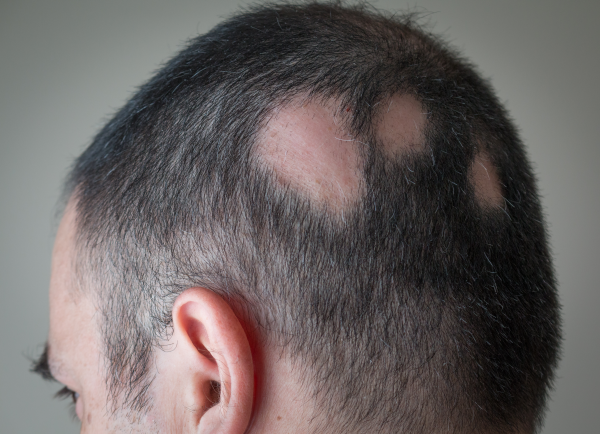 kebotakan tidak merata alopecia areata