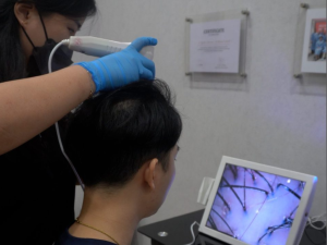 Analisa Rambut Mencegah Resiko Hair Transplant Gagal Tumbuh